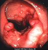 4-colon-cancer-early-symptoms.jpg