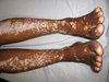 vitiligo_child_legs.jpg