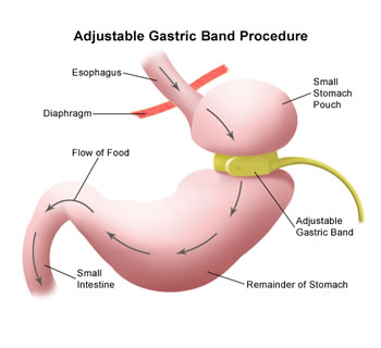 the+lap+band+adjustable+gastric+banding+system.jpg