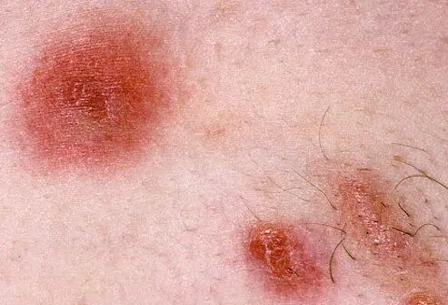 mrsa2-s2-mrsa-skin-infection.jpg