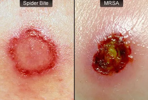 mrsa2-s3-spiderbite-mrsa.jpg