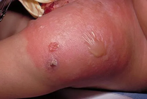 staph-infection-s5-photo-of-staphylococcal-infection-from-smallpox-vaccination.jpg