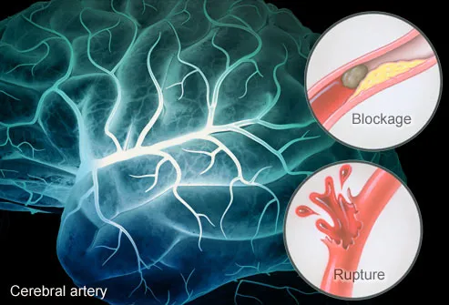 webmd_rm_illustration_of_stroke_causes_.jpg