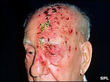 _47209157_m260158-shingles_attack_on_head_of_elderly_male,_5th_day-spl.jpg