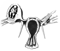 230px-Ectopic.png