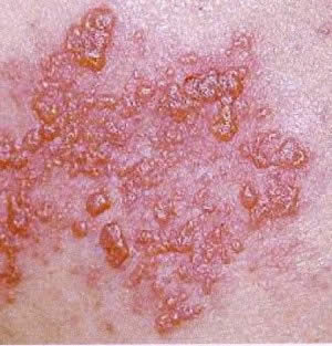 Herpes%20zoster%20shingles.jpg