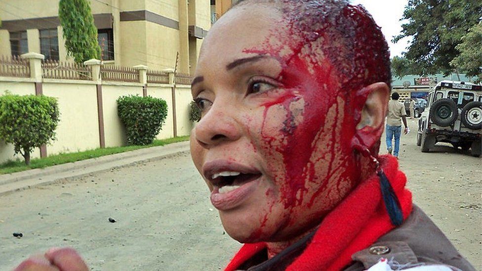 This photo made on January 5, 2011 shows Josephine Slaa, wife of an anti-graft campaigner, Wilbrod Slaa, a presidential contender who emerged second after Tanzania's re-elected President, Jakaya Kikwete, bleeding from a gash on her head after she was attacked by anti-riot police during a peaceful demonstration by supporters of the main opposition party CHADEMA