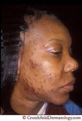 acne 1.jpg