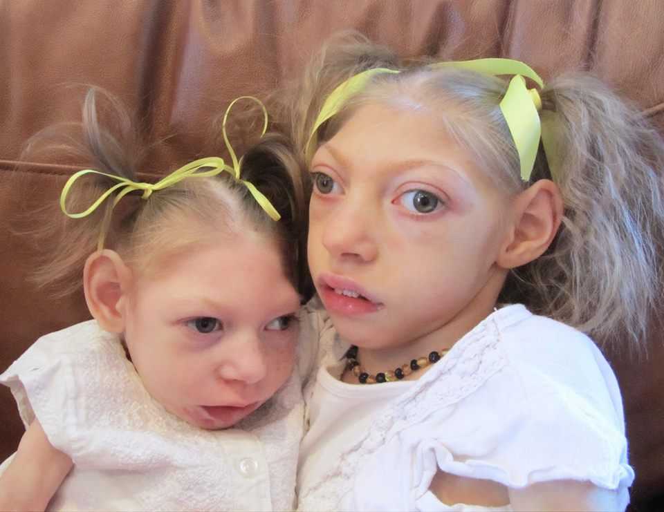 children-born-with-microcephaly.jpg