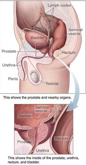 Chronic Bacterial Prostatitis.jpg