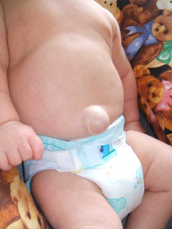 Hernia.jpg