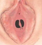 Septate-Hymen.jpeg