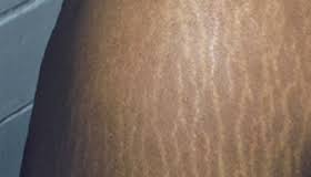 strecth marks 5.jpg