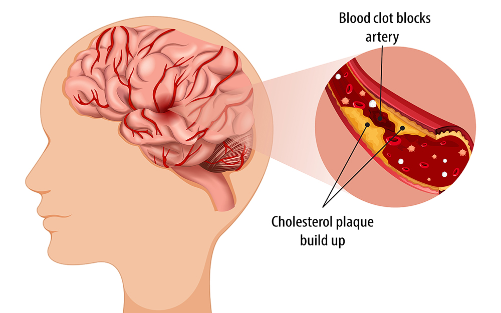 strokes-that-are-treatable-and-beatable.jpg