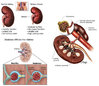 DiabeticNephropathy.jpg