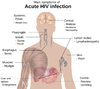 Symptoms_of_acute_HIV_infection.svg.jpg
