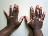 vitiligo_child_dark_skin.jpg