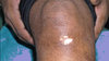 vitiligo_beginning_stage.jpg