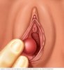Bartholin's Cyst.jpg