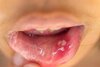 hpv-in-the-mouth.jpg