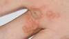 close-up-of-a-hand-with-warts-16x9.jpg