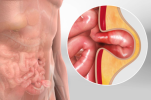 hernia.png