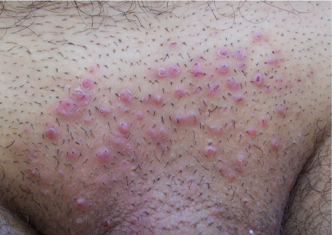 Fangasi Kwenye Vinywele Vya Sehemu Ya Siri