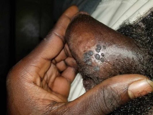 Surgical Excision (Upasuaji Mdogo)