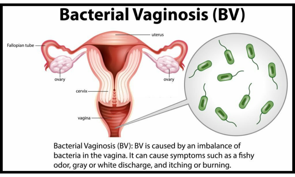 bacterial vaginosis