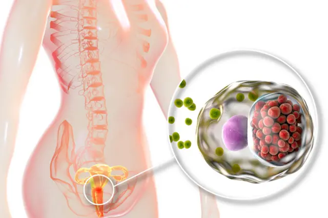 Chlamydia infection in a woman's body