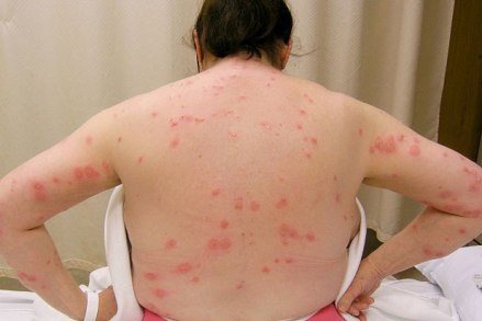 bed_bug_bites.jpg
