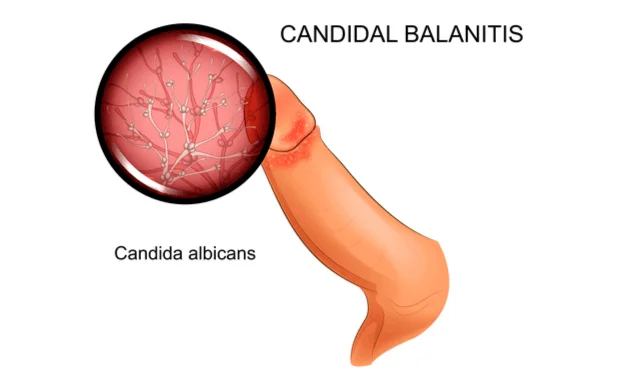 Candida Balanitis