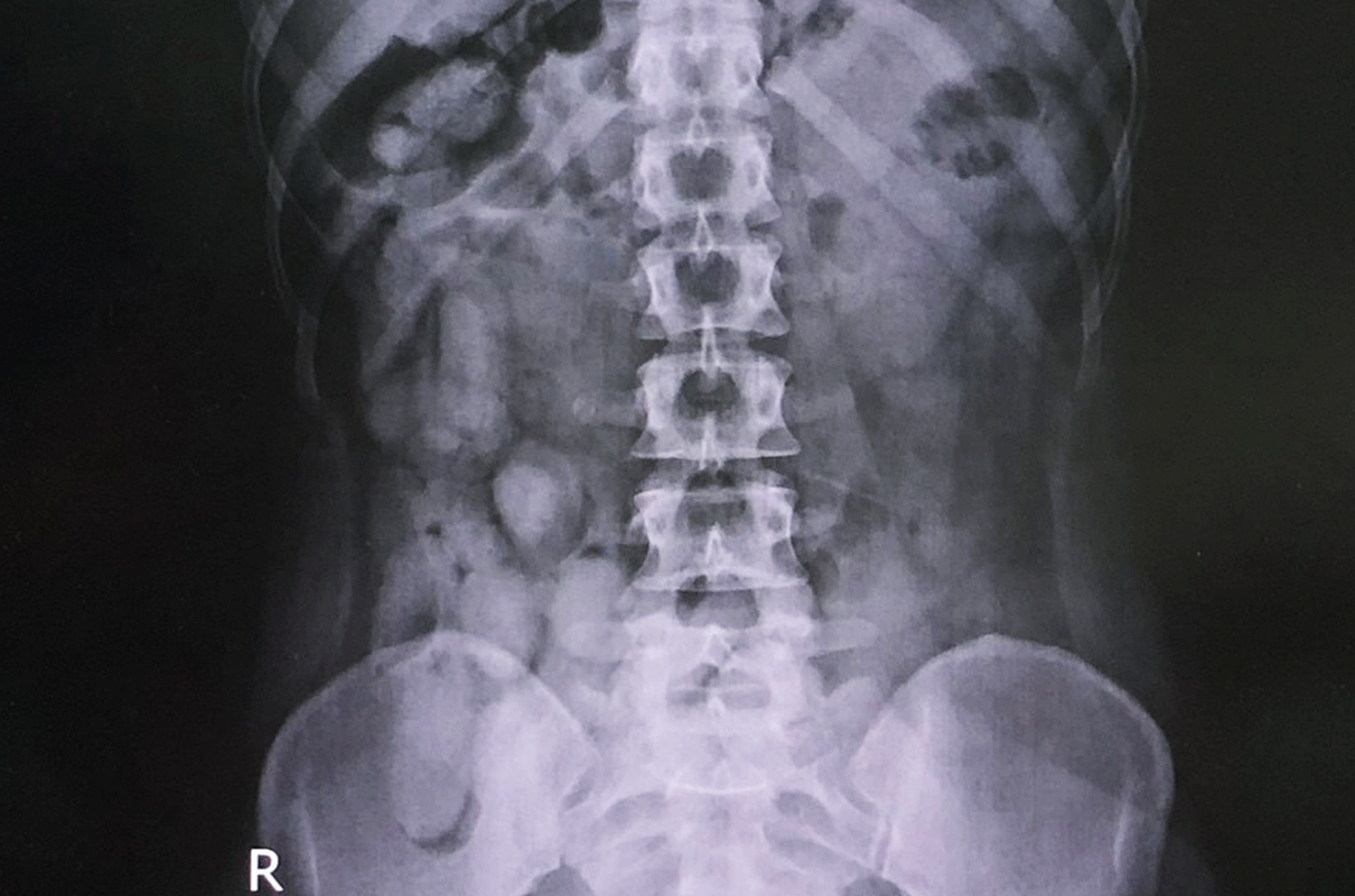 An X-ray shows cocaine in the stomach of one of three Kenyan woman who were arrested at Phuket airport and found to have been carrying drugs inside their bodies. (Photo: Sakhu police)