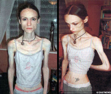 anorexia1.jpg