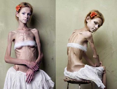 anorexia-nervosa2.jpg