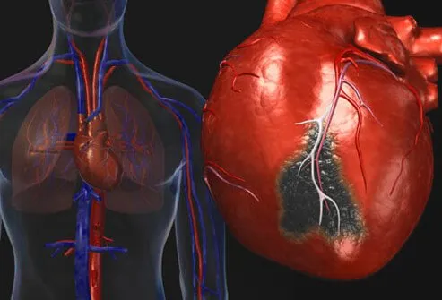 heart-disease-visual-guide-s2-heart-attack.jpg