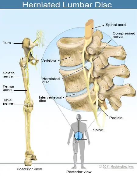 2011-herniated-lumbar-disc.jpg