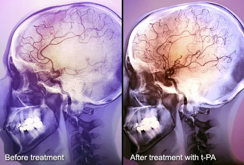 princ_rm_photo_of_angiogram_of-_stroke_patient_treated_with_tPA..jpg