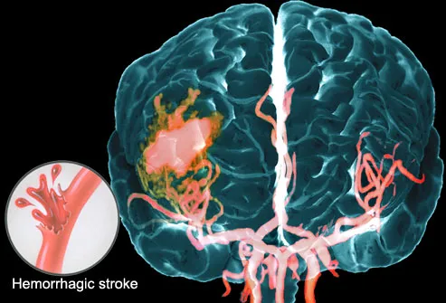 princ_rm_photo_of_mra_of_hemorrhagic_stroke.jpg