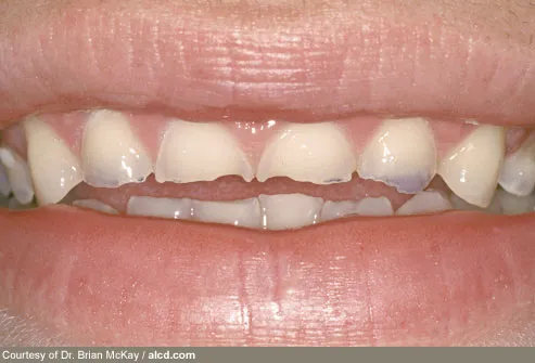 mckay_rm_photo_of_bulima_teeth.jpg