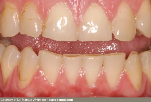 whitmore_rm_photo_of_teeth_damaged_by_bruxism.jpg