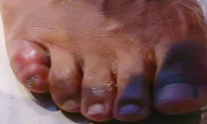 David-hayes-broken-toe-005.jpg