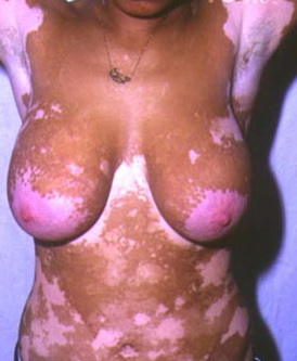 vitiligo1.jpg