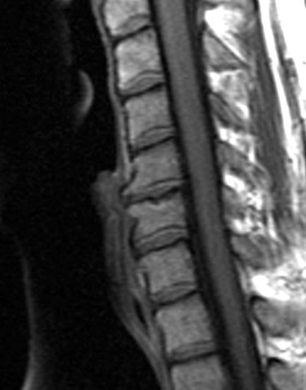 Cervical_Spine_MRI_showing_degenerative_changes_closeup.jpg