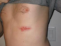 250px-Shingles_on_the_chest.jpg