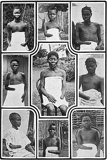 220px-MutilatedChildrenFromCongo.jpg