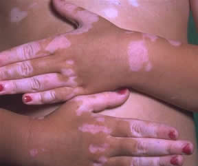 167883d1282807360-ibrahim-saracoglu-vitiligo-1-.jpg