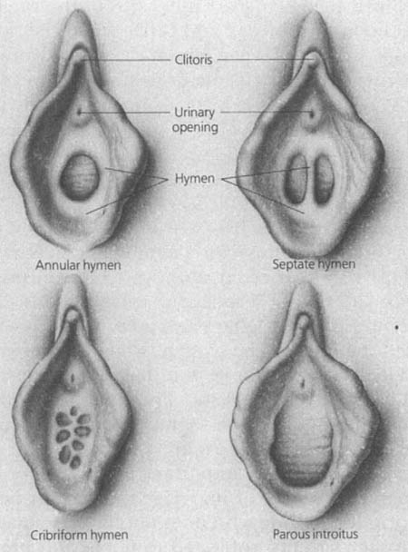 Different-types-of-hymen.jpg