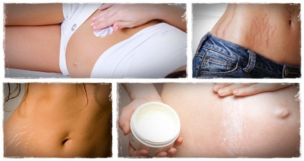 Remove-Stretch-Marks-620x330.jpg