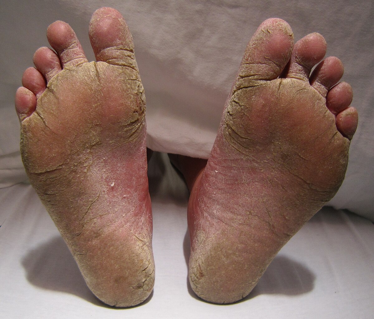 1200px-FeetFungal.JPG